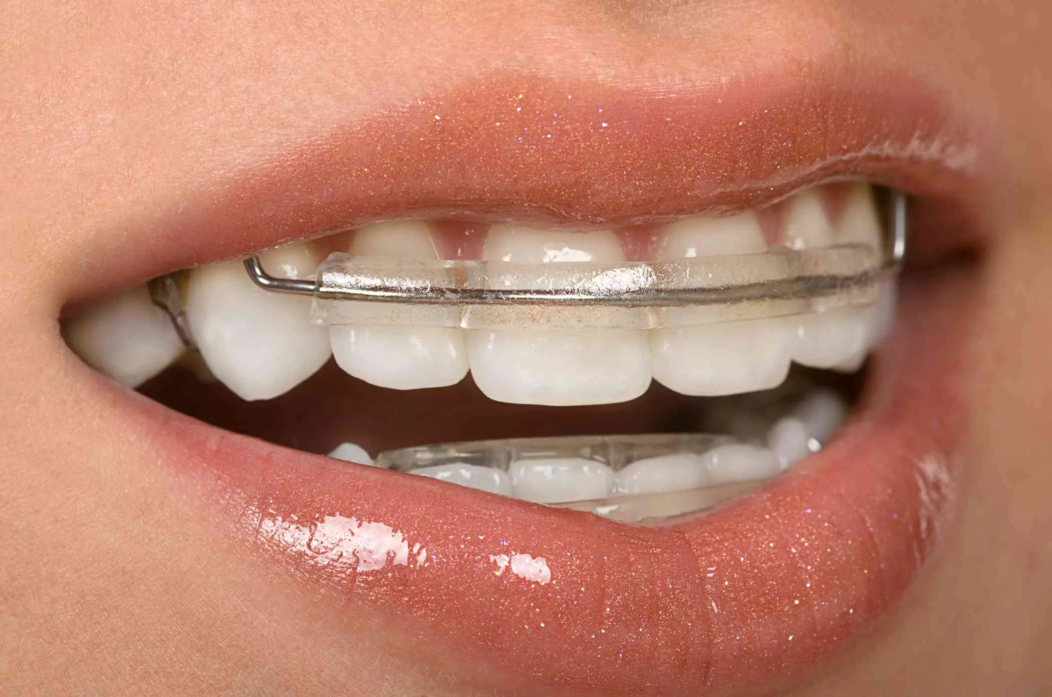 Why Is Retainer Use Important?