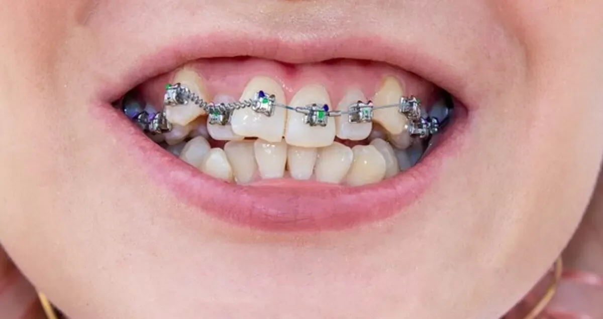 What Causes Crowded Teeth?
